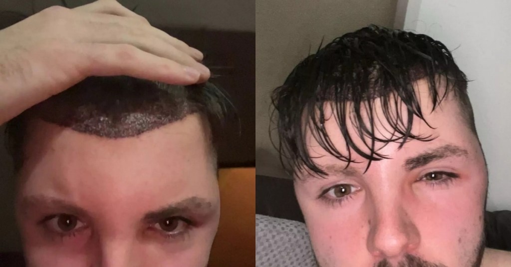 This Is What Happens When You Break the ‘No Sex Rule’ After a Hair Transplant